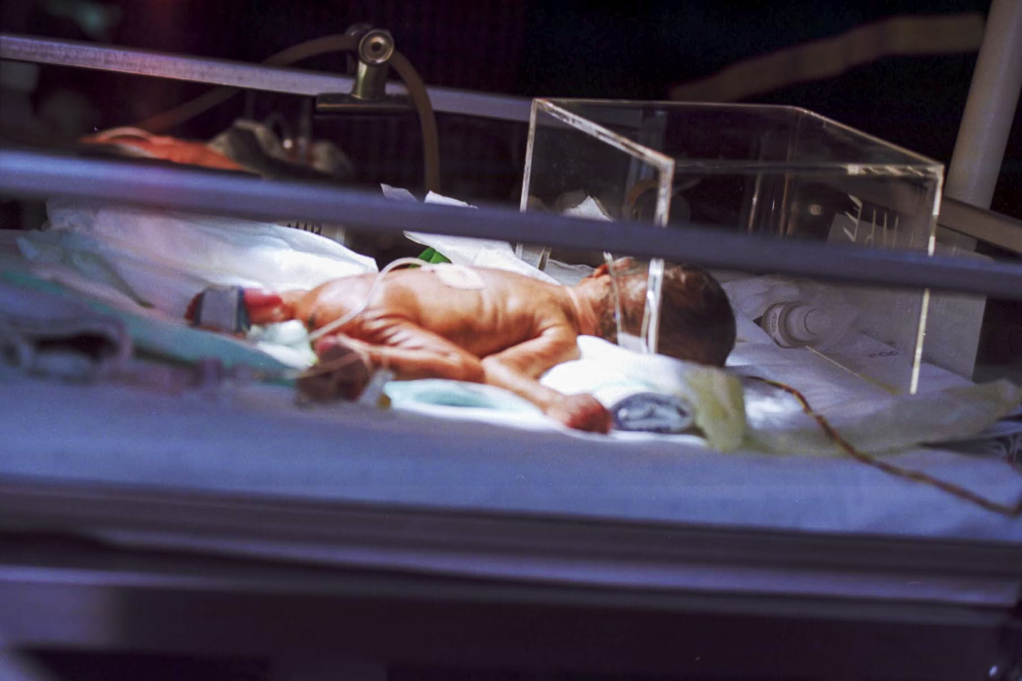 Exploring the Science and Medical Evidence Underpinning NEC Formula Lawsuits