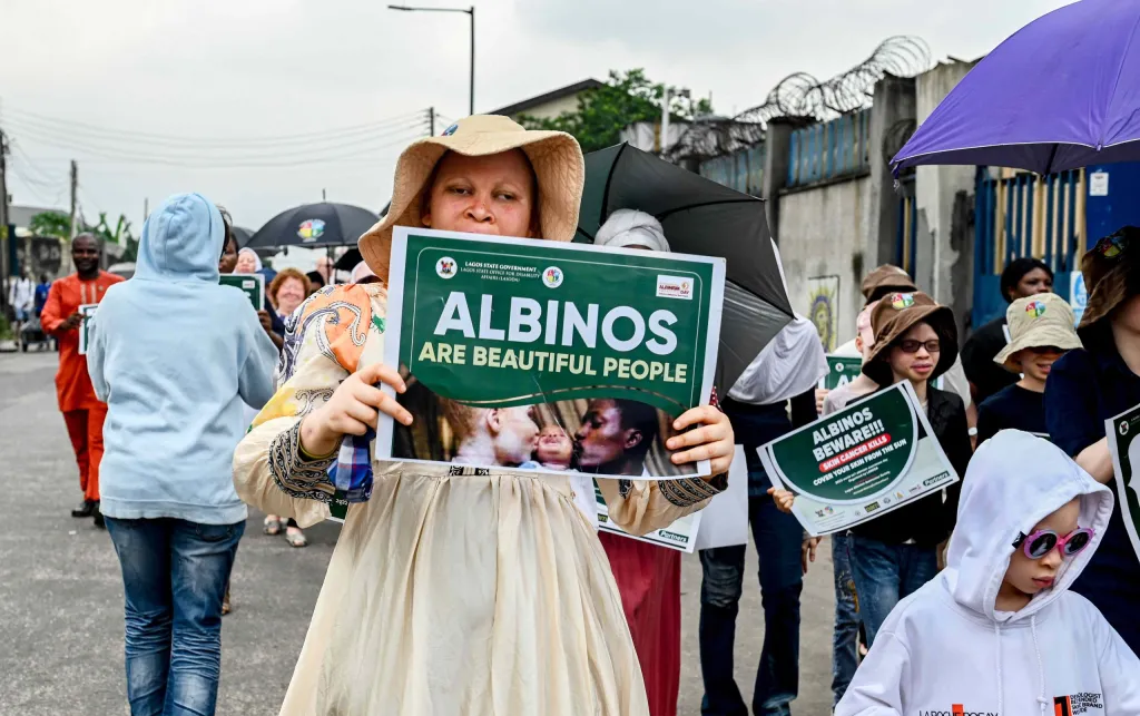 People With Albinism Urged To Focus On Preventive Tips Against Skin Cancers, Others