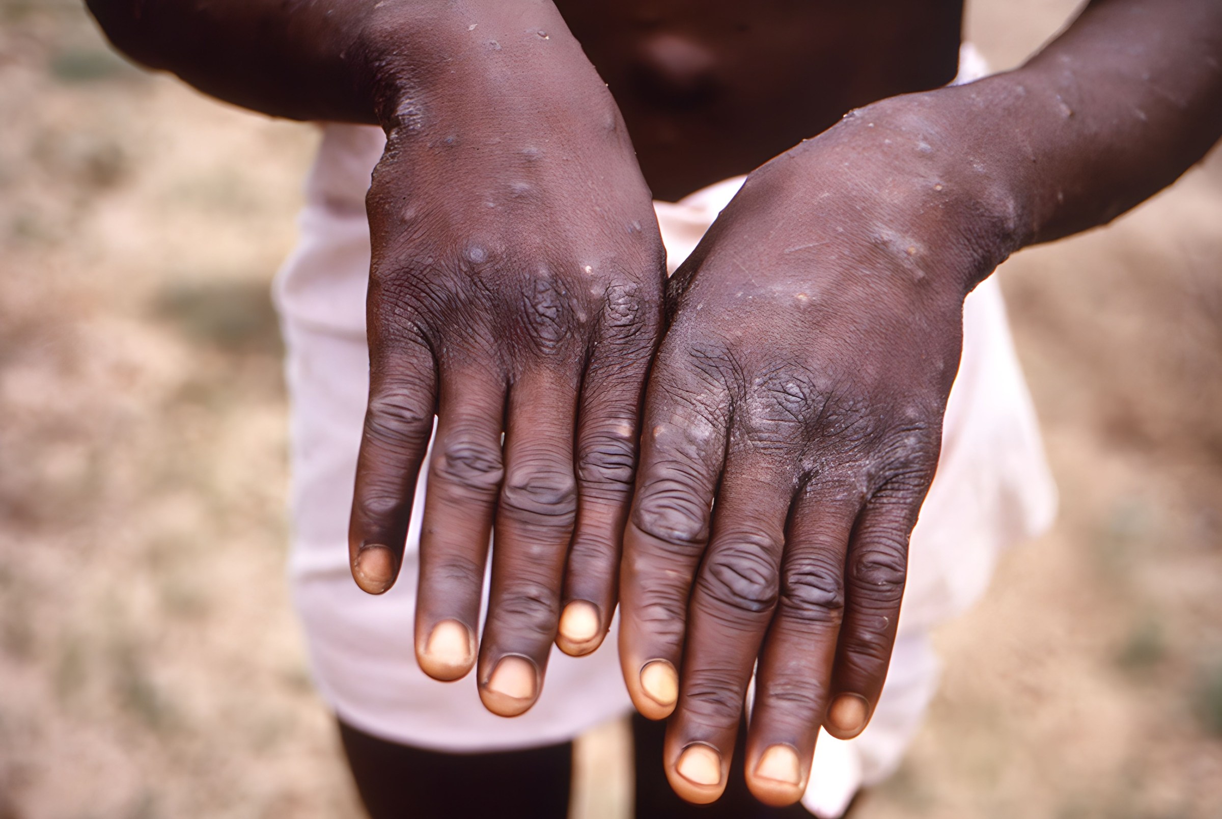 ECOWAS Reacts To Monkeypox Outbreak 