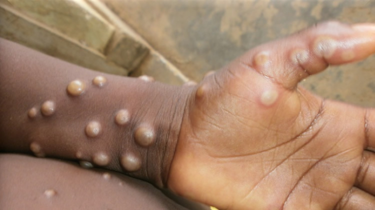 FG Announces Date To Begin Mpox Vaccination 