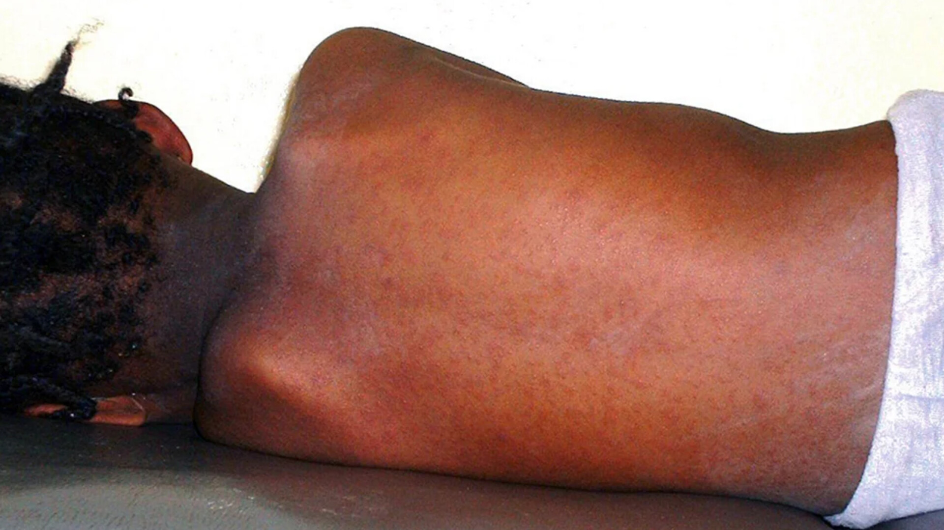 Over 1m Children targeted for Measles vaccination in Anambra