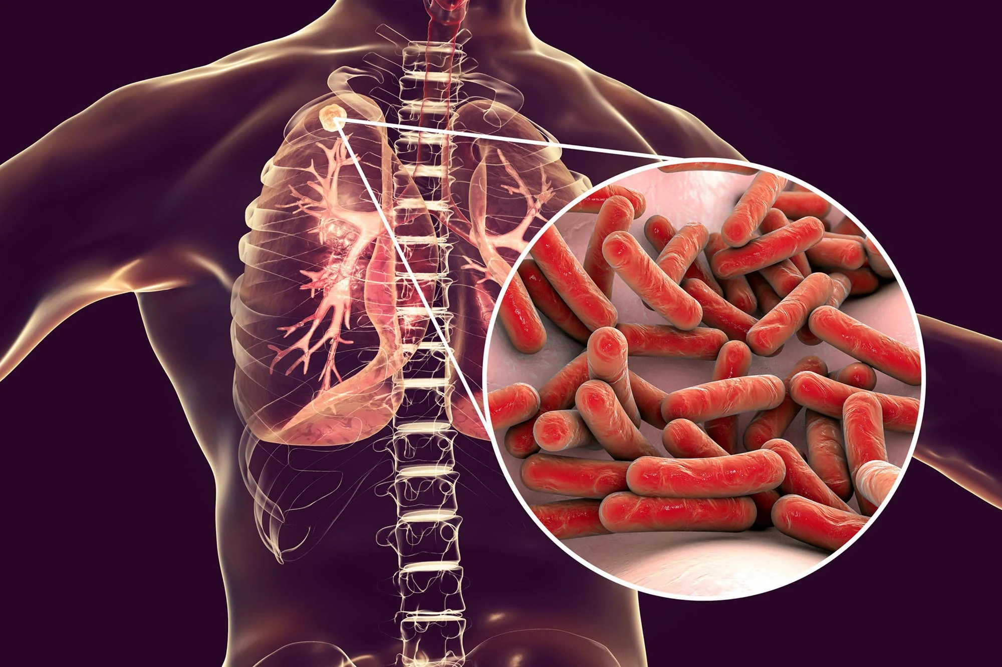 Lagos Battles Rising Tuberculosis Cases